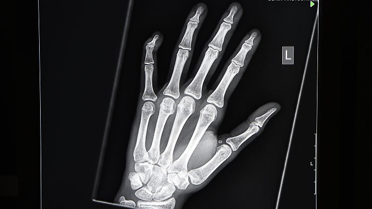 Über die radiologische Untersuchung des Handwurzelknochens und der Hand lässt sich das etwaige Alter eines Menschen bestimmen. In Hamburg und Berlin werden bei der Altersbestimmung von jungen Flüchtlingen auch die Genitalien begutachtet, allerdings ohne Zwang.