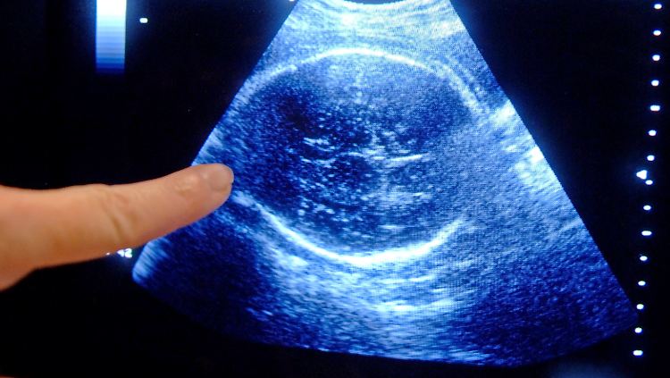 Drei Ultraschall-Untersuchungen gehören zum Standard - eines pro Trimester. Viele Frauen lassen aber fünf und mehr vornehmen.