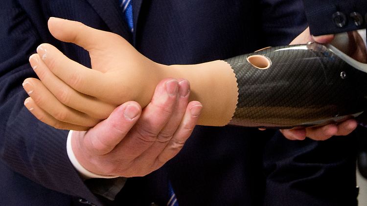 "Normale" Handprothesen sind teuer - vor allem für Kinder, da sie noch wachsen und immer wieder neue angepasste Prothesen brauchen.