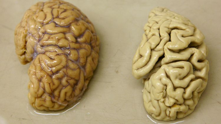 Teil des Gehirns eines gesunden Menschen (l.) neben dem eines Alzheimer-Patienten.
