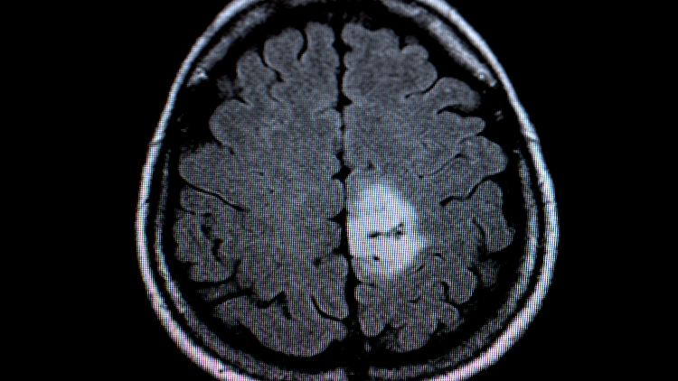 MRT-Bild des Gehirntumors (heller Fleck).