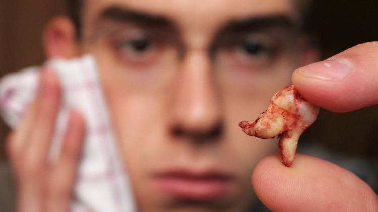 Ein junger Mann trauert seinem frisch gezogenen Weisheitszahn nach und kühlt sich dabei Wange.