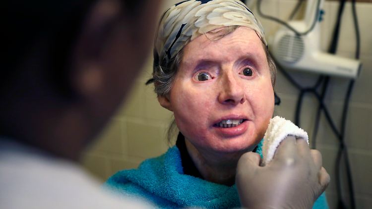 Charla Nash bekam 2011 ein neues Gesicht. Die Transplantation war erst die dritte dieser Art in den USA.