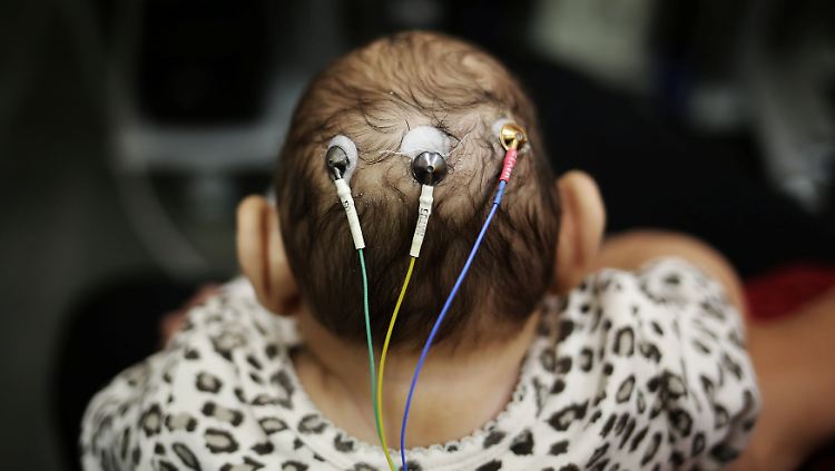 Baby, das an Mikrozephalie erkrankt ist, bei einer Untersuchung.
