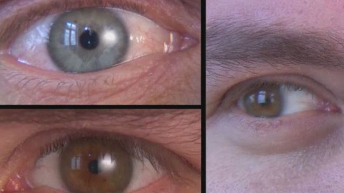 Augenlaser.JPG