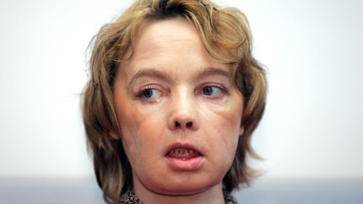 Nachdem Isabelle Dinoire durch Hundebisse die Lippen, ihre Nase und das Kinn verloren hatte, transplantierten Ärzte ihr dieses neue Gesicht.