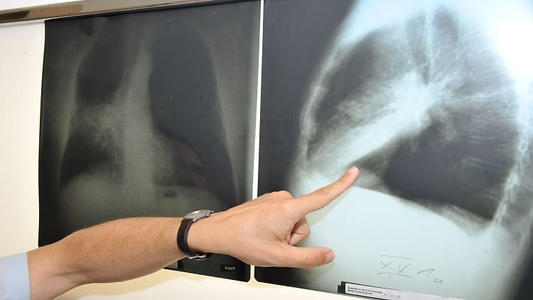Röntgenbild einer mit Krebs befallenen Lunge.