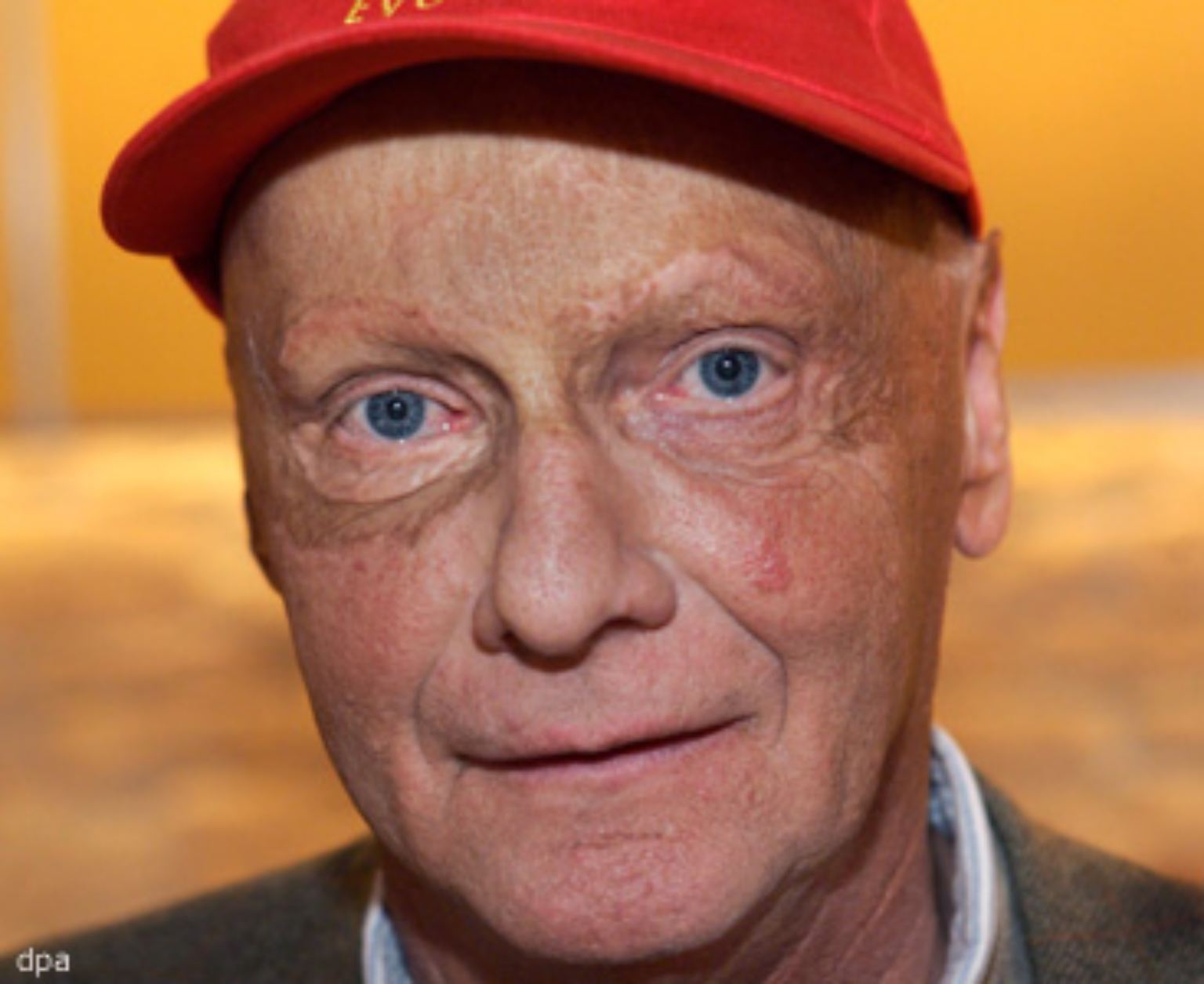 Das markante, vernarbte Gesicht Niki Laudas kennt wohl jeder. Sein spektakulärer Unfall, der wahrscheinlich bekannteste und meistgezeigte der Formel 1, liegt mittlerweile 30 Jahre zurück.