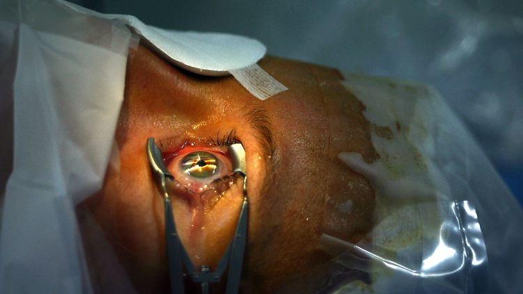 Lasern kostet ab 800 Euro pro Auge. Schön, wenn die Kasse zahlt. 