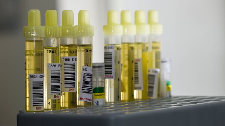 Ein Urintest für Alzheimer wäre sehr hilfreich für eine frühzeitige Therapie.