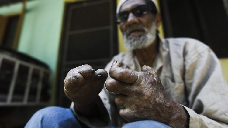 Lepra-Patient in Indien: Die chronische Krankheit ist zwar mit einer monate- bis jahrelangen Medikamentengabe heilbar, aber wenn sie zu spät diagnostiziert wird, bleiben erhebliche körperliche Schäden.