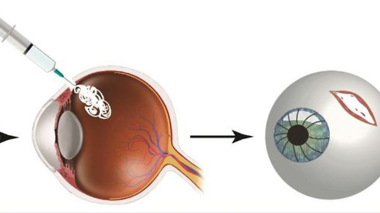 Forscher haben ein Gel zur Behandlung von Augenverletzungen entwickelt.