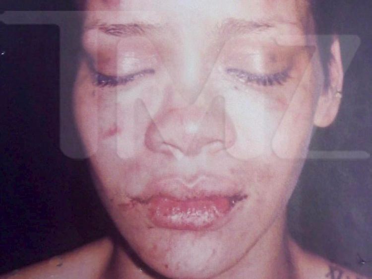 Das Bild ging um die Welt: Rihanna nach der Prügelattacke von Chris Brown.