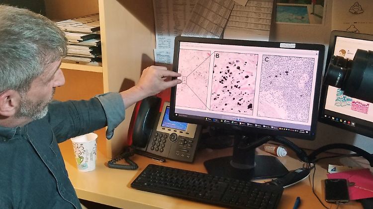 Studienleiter und Pathologe Neil Theise sagt, Proben der Gewebeflüssigkeit könnten ein wichtiges Diagnosewerkzeug werden.