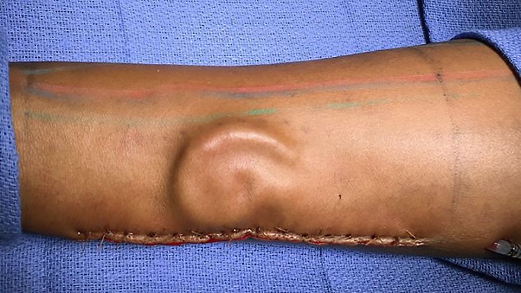 Ärzte verpflanzen Knorpel in Form eines Ohres in den Unterarm der Patientin.