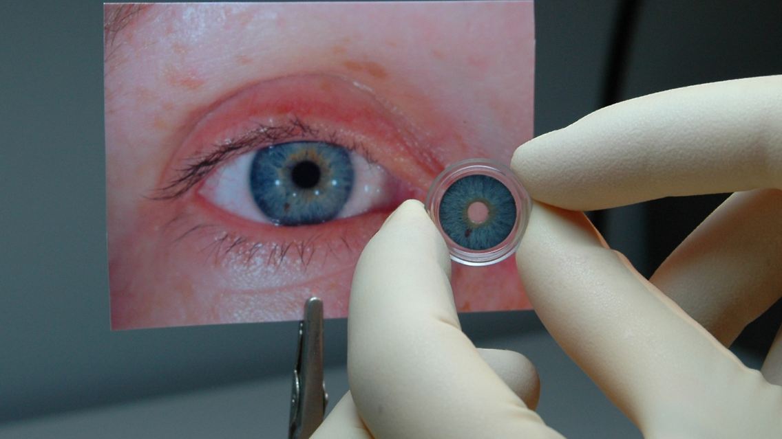 Mit der künstlichen Iris des Unternehmens werden Patienten behandelt, die ihre Iris durch einen Unfall teilweise oder vollständig verloren haben oder von Geburt an keine Iris besitzen.