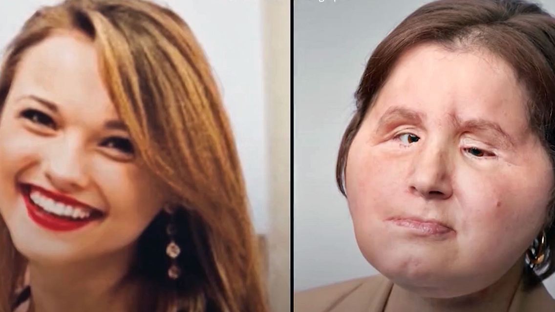 Gesichtstransplantation.jpg