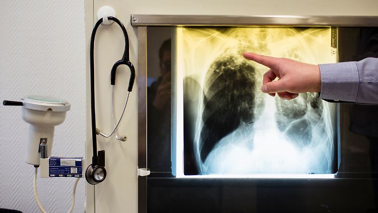 Wird Tuberkulose einmal diagnostiziert, helfen Antibiotika bei der Heilung.