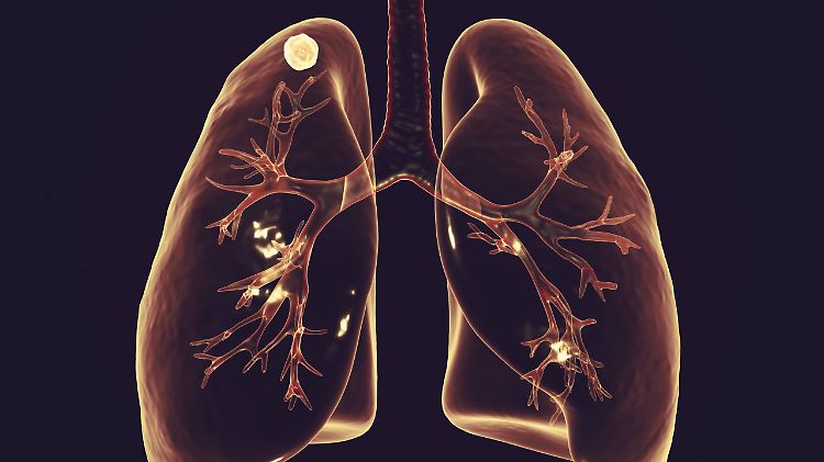 Das Computerbild zeigt, wie eine tuberkuloseinfizierte Lunge aussieht.