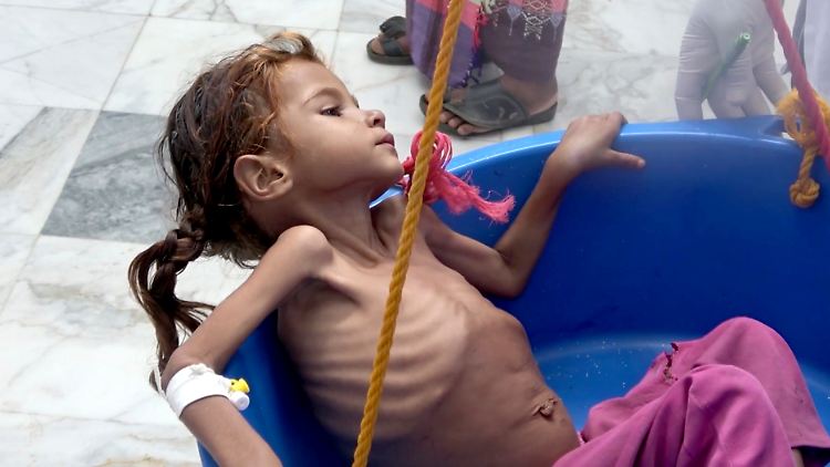 Amal Hussein war derart unterernährt, dass sie Anfang November in Hajjah nordwestlich der jemenitischen Hauptstadt Sanaa starb.
