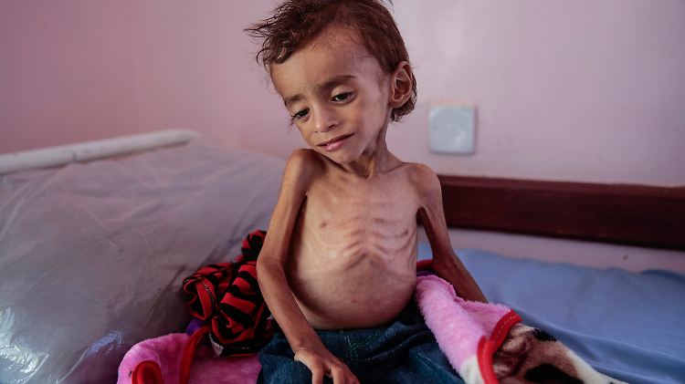 Ein unterernährter Junge wird in einer Klinik in Hajjah medizinisch versorgt.