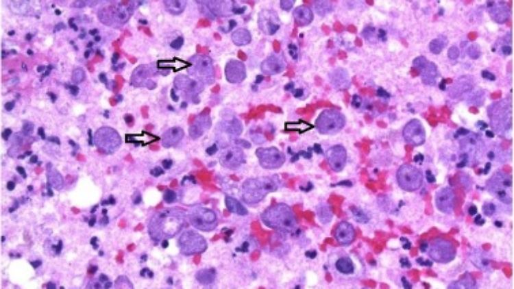Mikroskopisches Bild vom Gewebe der Frau. Die Pfeile zeigen lebensfähige Balamuthia mandrillaris-Trophozoiten an.