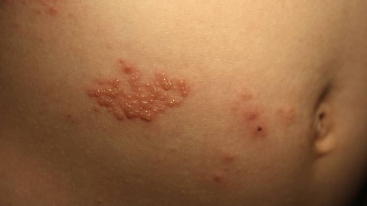 Herpes zoster verursacht schmerzende Bläschen auf der Haut. Diese sind ansteckend.