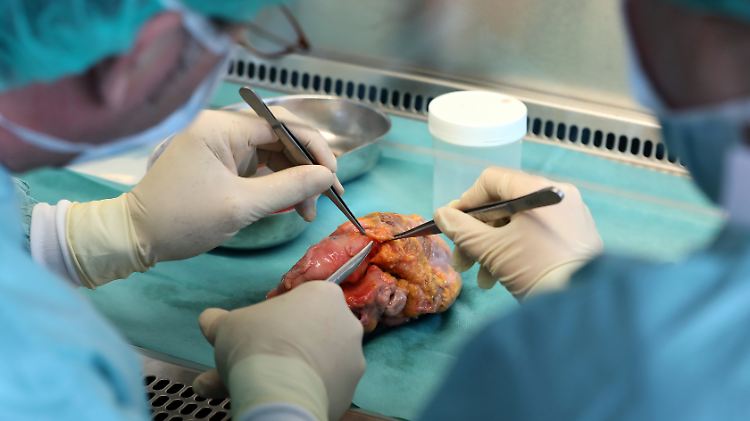Die Zahl der Organspender hat 2017 ein Minus erreicht.