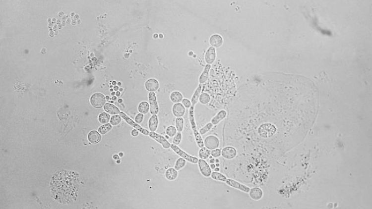 Die mokroskopische Aufnahme zeigt Candida albicans.
