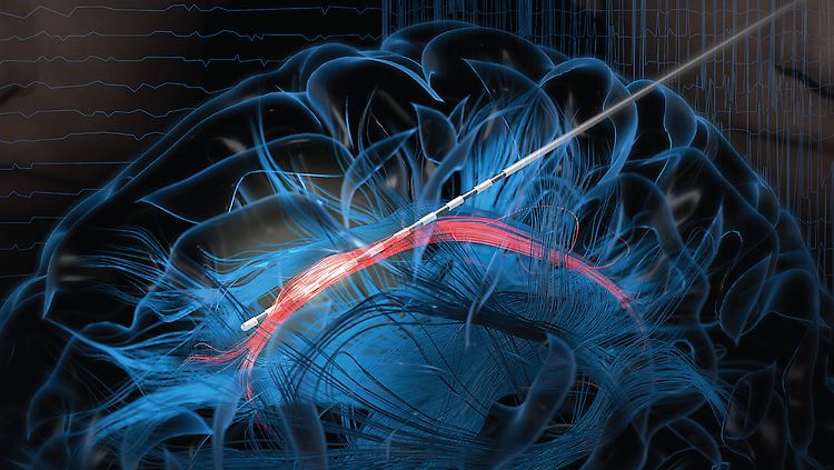 Die Computersimulation zeigt, wie eine Elektrode in die Gürtelwindung des Gehirns eingeführt wird. 
