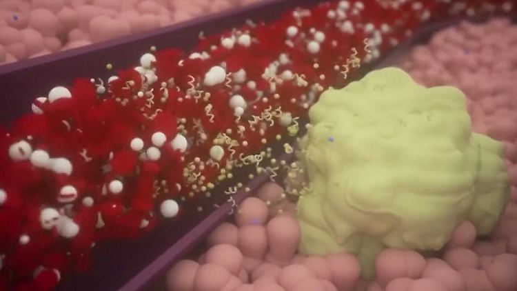 Brustkrebs Bluttest.JPG