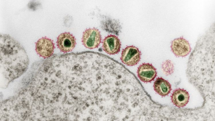 Bei dem Patienten ist das HIV-Virus seit drei Monaten nicht nachweisbar. 