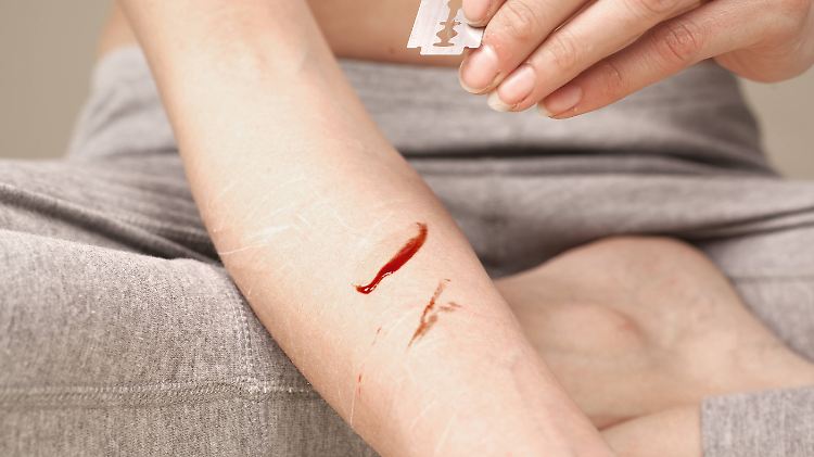 Jugendliche verletzen sich meist an Armen oder Beinen, dort können sie Schnitte  oder Narben gut verstecken.