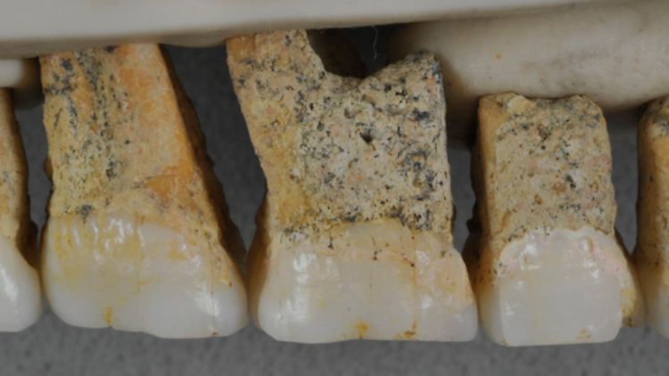 Öberzähne von Homo luzonensis CCH6.