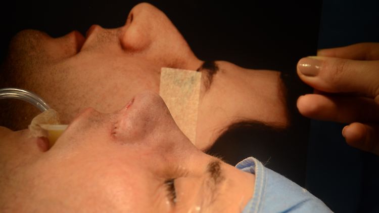 Die operierte Nase eines Mannes in einer Privatklinik in Rio de Janeiro, im Hintergrund wird ein Bild hochgehalten, das die Nase vor der Operation zeigt.