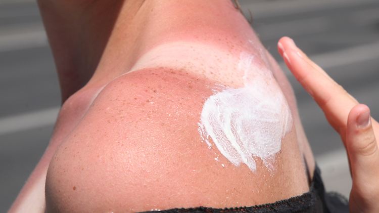 Zu spät: Jeder Sonnenbrand schädigt die Haut.