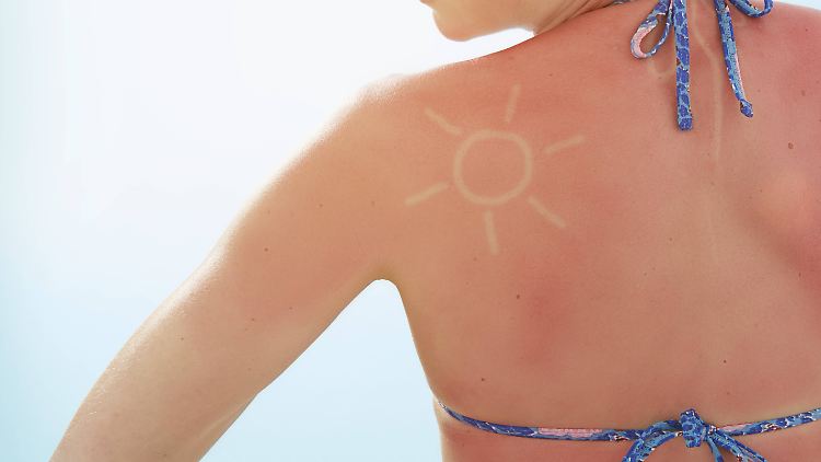 Nach einem Sonnenbrand schafft eine After-Sun-Lotion Linderung.