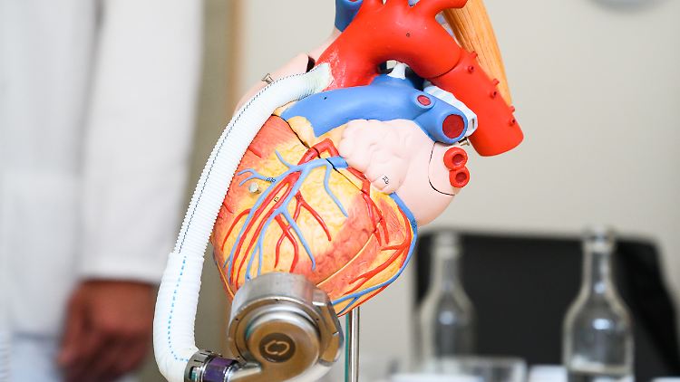 An dem Modell eines Herzens ist der "HeartMate 3" als Unterstützungssystem angebracht. 