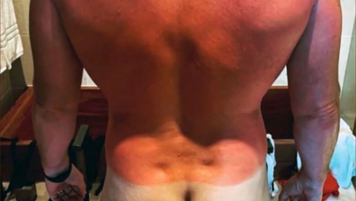 ChrisPrattSonnenbrand.jpg
