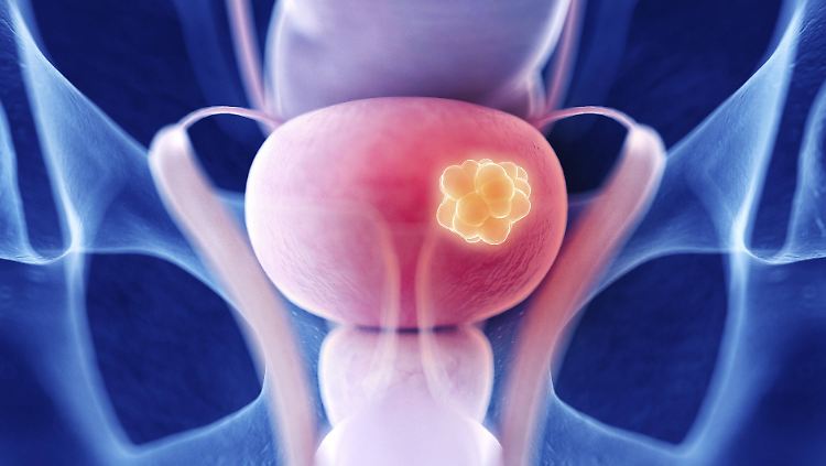Die Darstellung zeigt einen Tumor in der Harnblase.