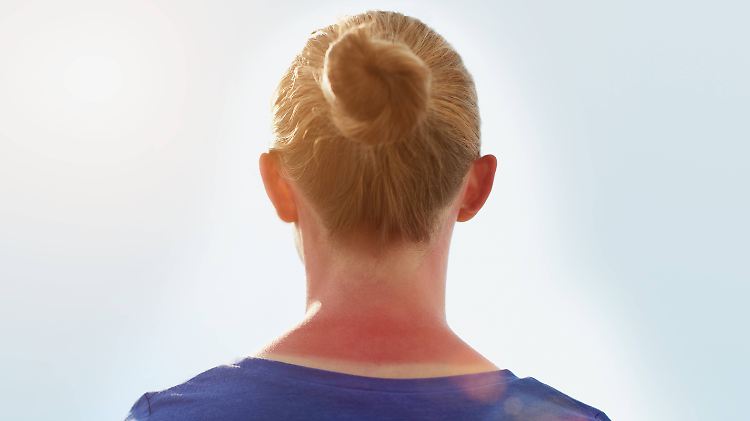 Die KKH vermutet einen Zusammenhang zwischen Klimawandel und steigenden Hautkrebs-Erkrankungen.