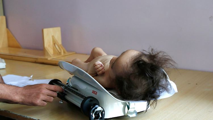 Lebensbedrohlich: Im Jemen haben laut Unicef etwa 350.000 Kinder unter fünf Jahren nicht genügend zu essen.