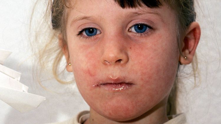 Mädchen mit Masern: Masern schwächen das Immunsystem nicht nur während der Krankheit, sondern auch noch danach.