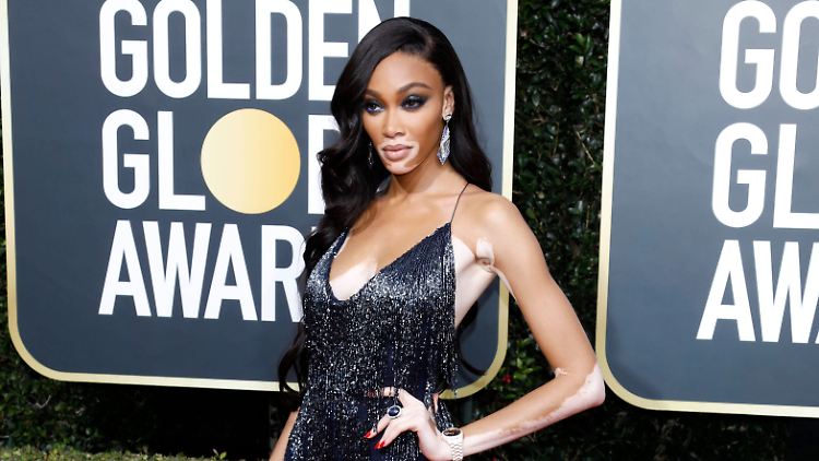 Winnie Harlow ist nicht nur aufgrund ihrer Pigmentflecken ein weltweit gebuchtes Model.