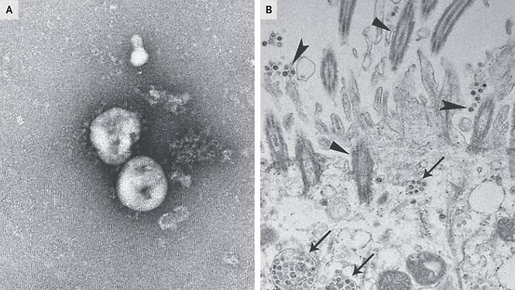 Das chinesische Coronavirus-Forschungsteam veröffentlichte diese Bilder, die per Transmissionselektronenmikroskopie entstanden.
