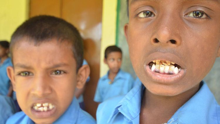 Indische Kinder, die aufgrund des hohen Fluoridgehalts im Wasser in ihrem Dorf von Fluorose betroffen sind - in Deutschland gibt es nach Angaben von Zahnmediziner Zimmer kaum Probleme mit Zahnfluorose.
