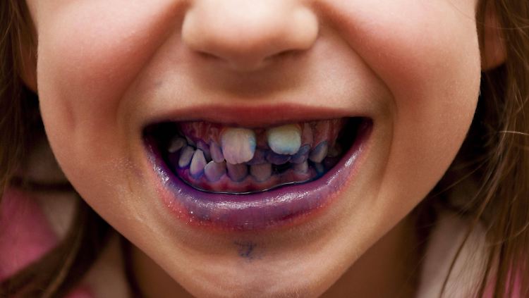 Bei Prophylaxe-Terminen für Kinder werden seit Jahrzehnten plaquefärbende Kautabletten eingesetzt.