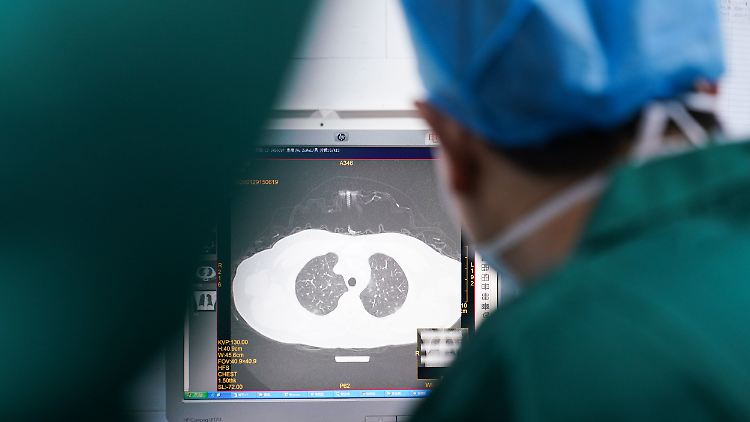 Wissenschaftler vermuten bleibende Lungenschäden bei schwer erkrankten und wieder genesenen Corona-Patienten.