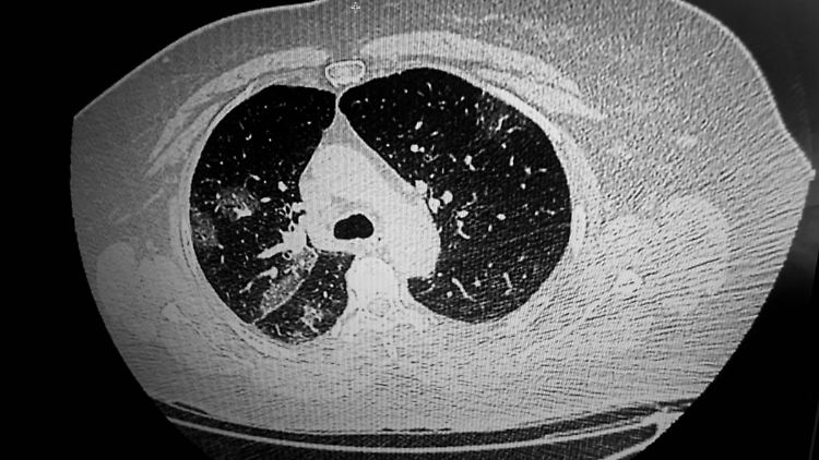 Das CT-Bild zeigt die Lunge eines Covid-19-Patienten. 