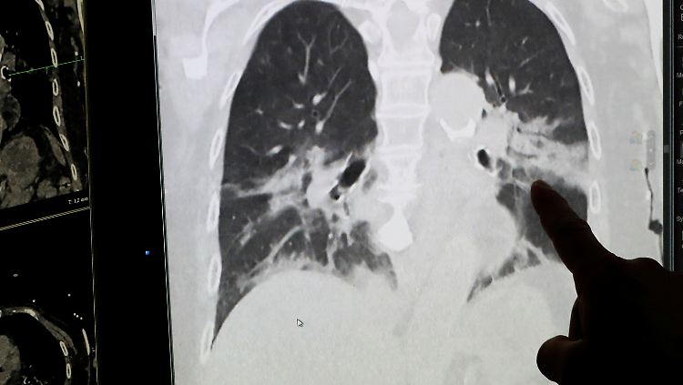 Radiologen können die Lungenschäden sowohl im Röntgen- als auch im CT-Bild sehen.